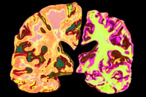 Should we all be taking low doses of lithium to prevent Alzheimer’s?